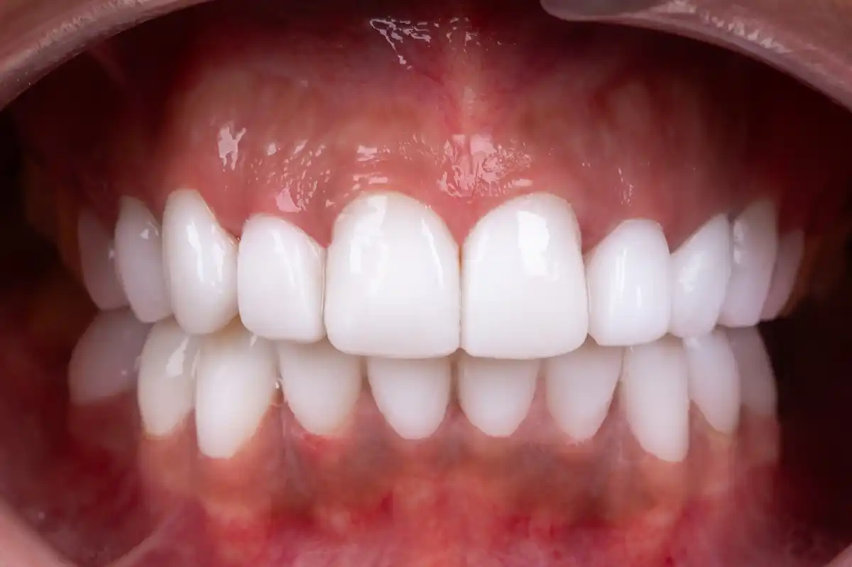 Avant implant dentaire Tunisie – dent manquante patient 1 Implant Dentaire Tunisie Tunis