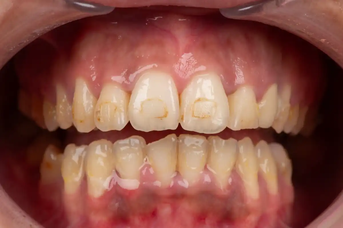 Après implant dentaire Tunisie Nobel Biocare – couronne zircone résultat Implant Dentaire Tunisie