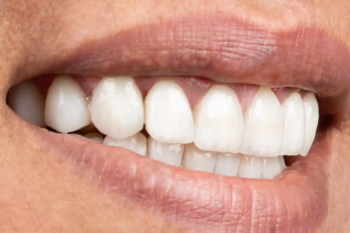 Avant All-on-4 Tunisie – arcade édentée patient 1 Implant Dentaire Tunisie