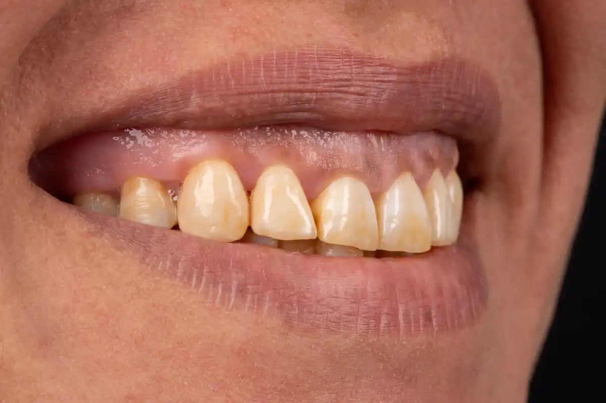 Après All-on-4 Tunisie Nobel Biocare – prothèse zircone fixe