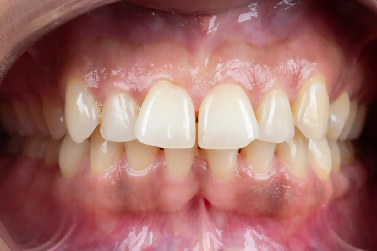 Après All-on-4 Tunisie Nobel Biocare – prothèse zircone fixe résultat Implant Dentaire Tunisie