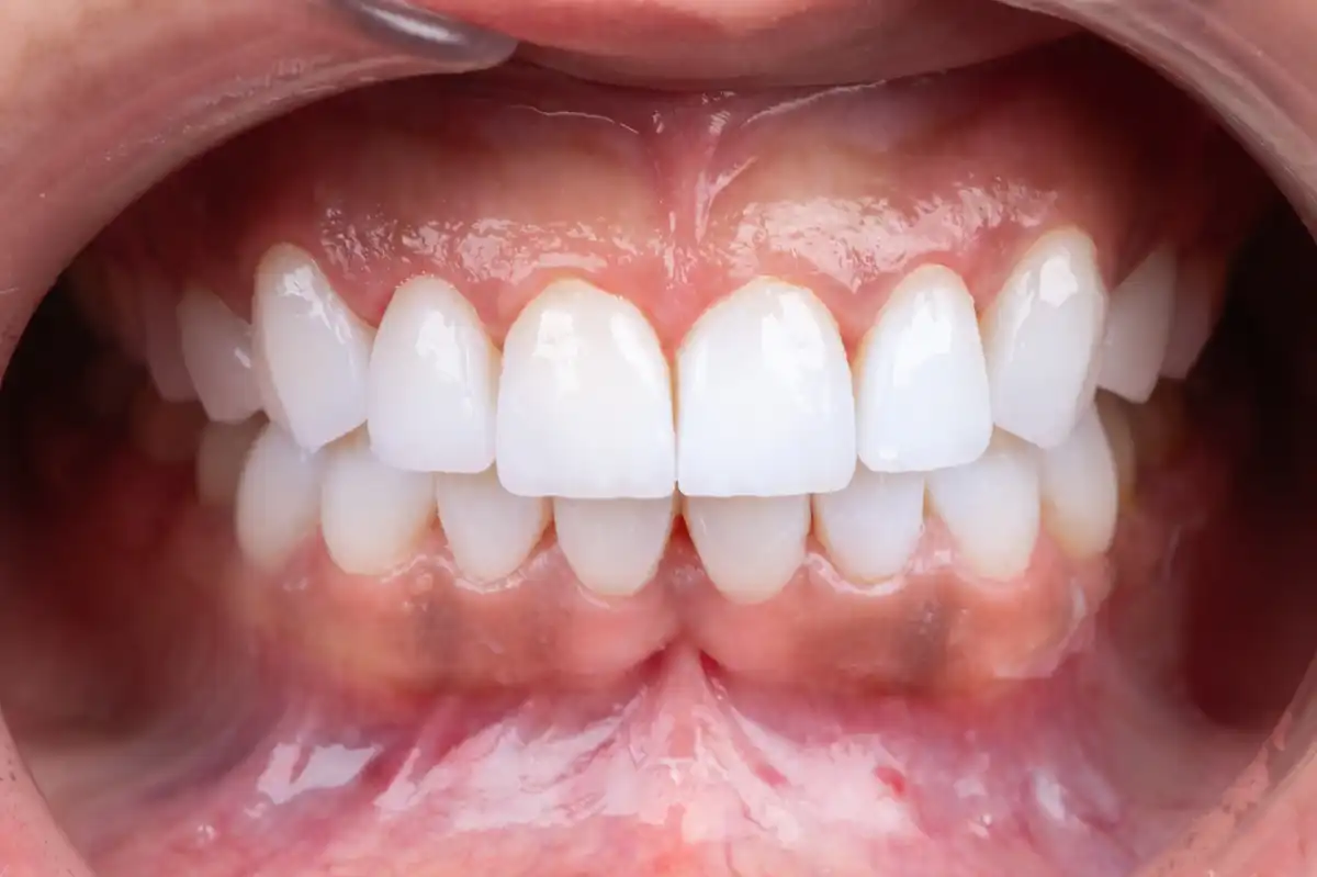 Avant All-on-4 Tunisie – arcade édentée patient 1 Implant Dentaire Tunisie