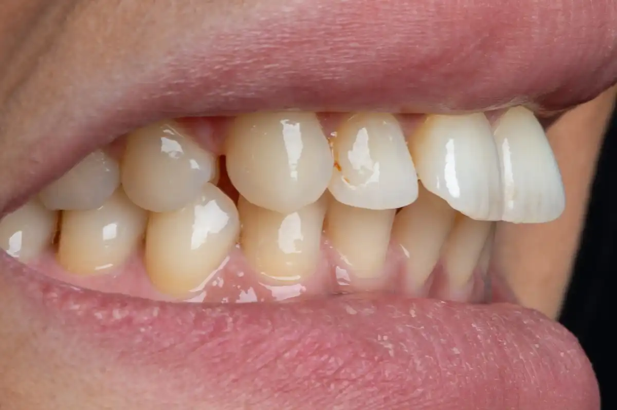 Après All-on-4 Tunisie – extraction + implants immédiats arcade mandibulaire Implant Dentaire Tunisie