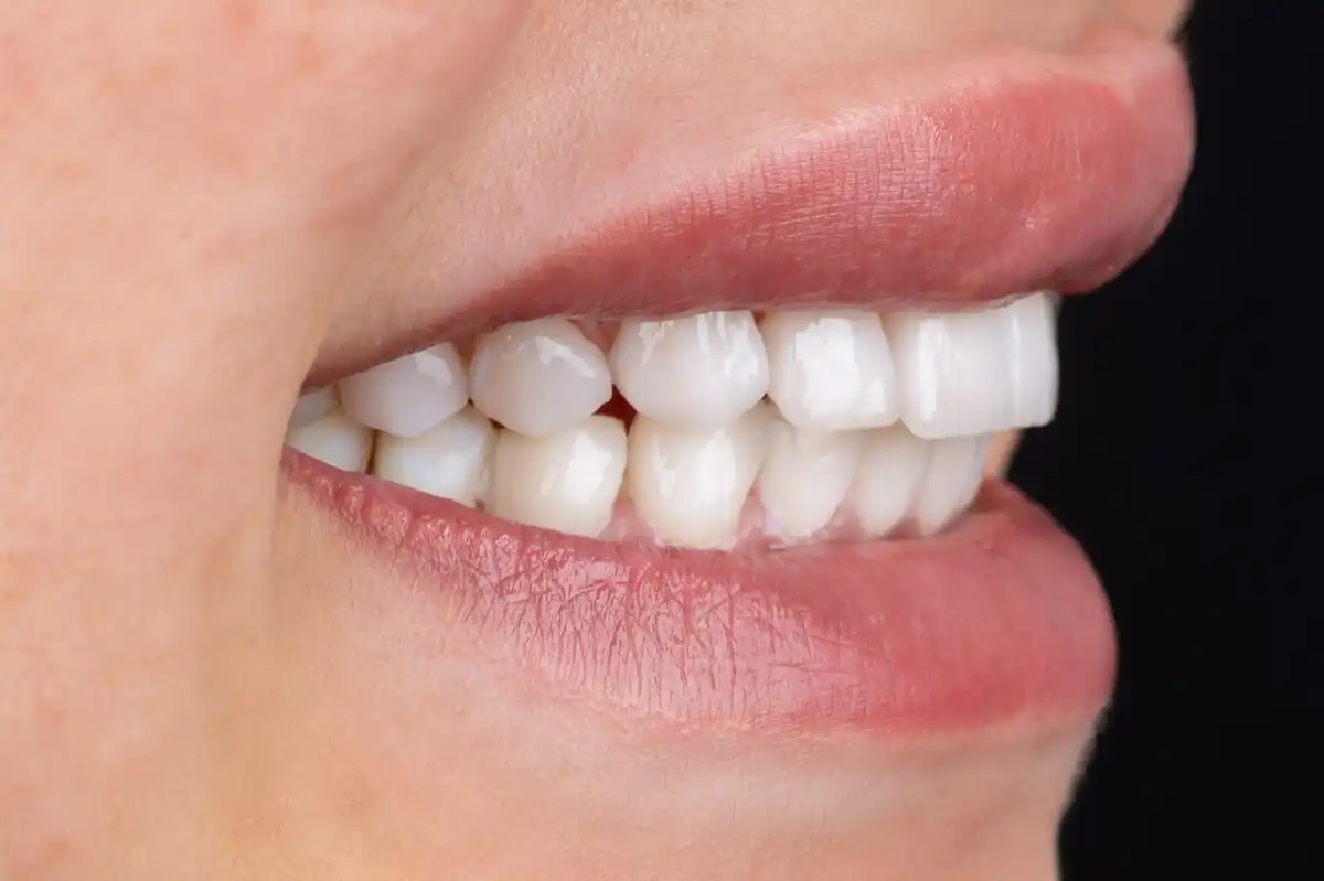 Avant All-on-4 Tunisie – parodontite avancée multiples extractions patient 3 Implant Dentaire Tunisie