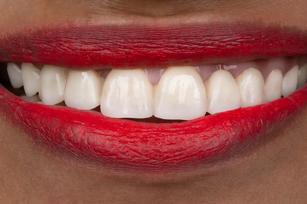 Avant All-on-4 Tunisie – prothèse amovible instable patient 2 Implant Dentaire Tunisie