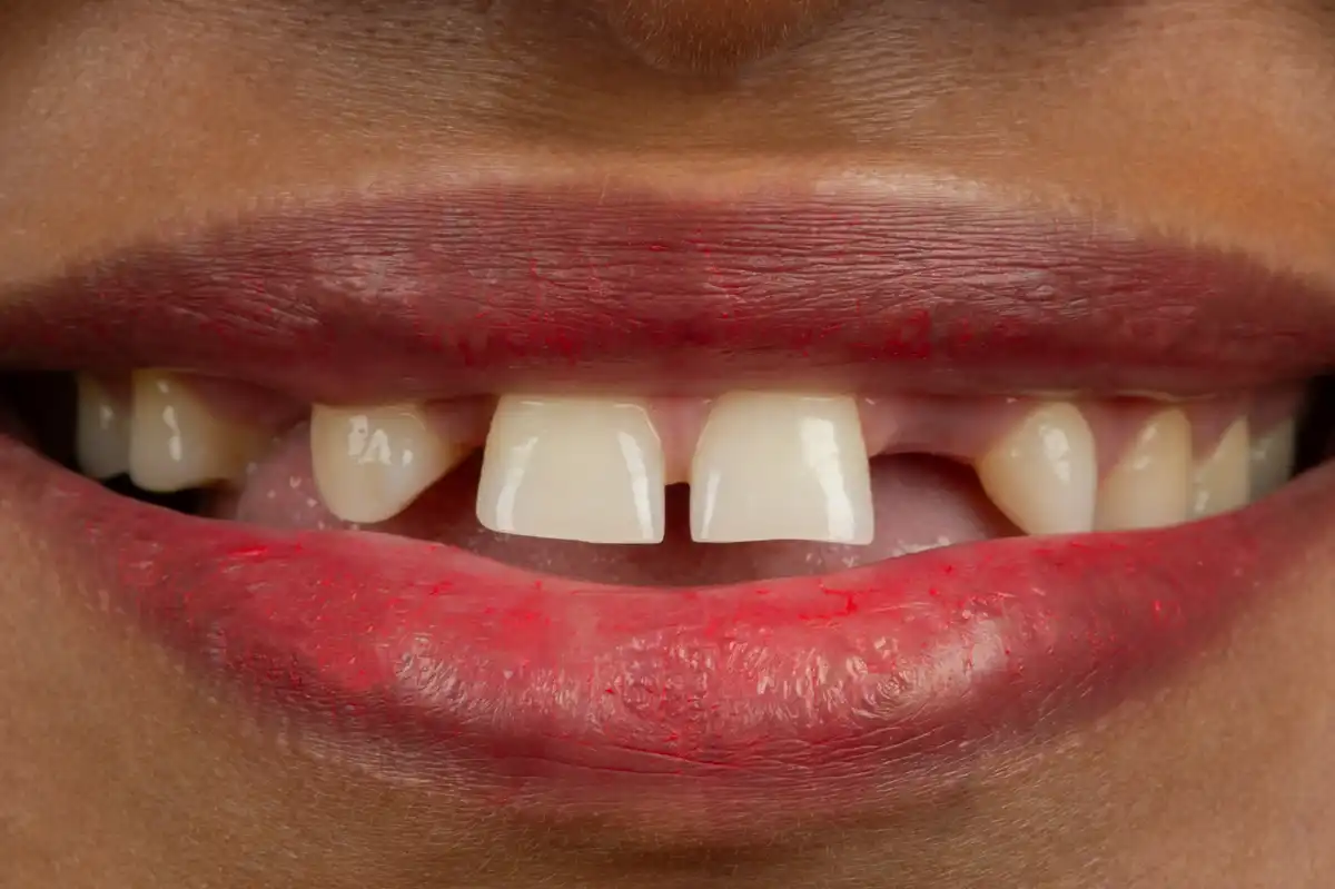 Après All-on-4 Tunisie – 2 arcades fixes résultat Implant Dentaire Tunisie Tunis