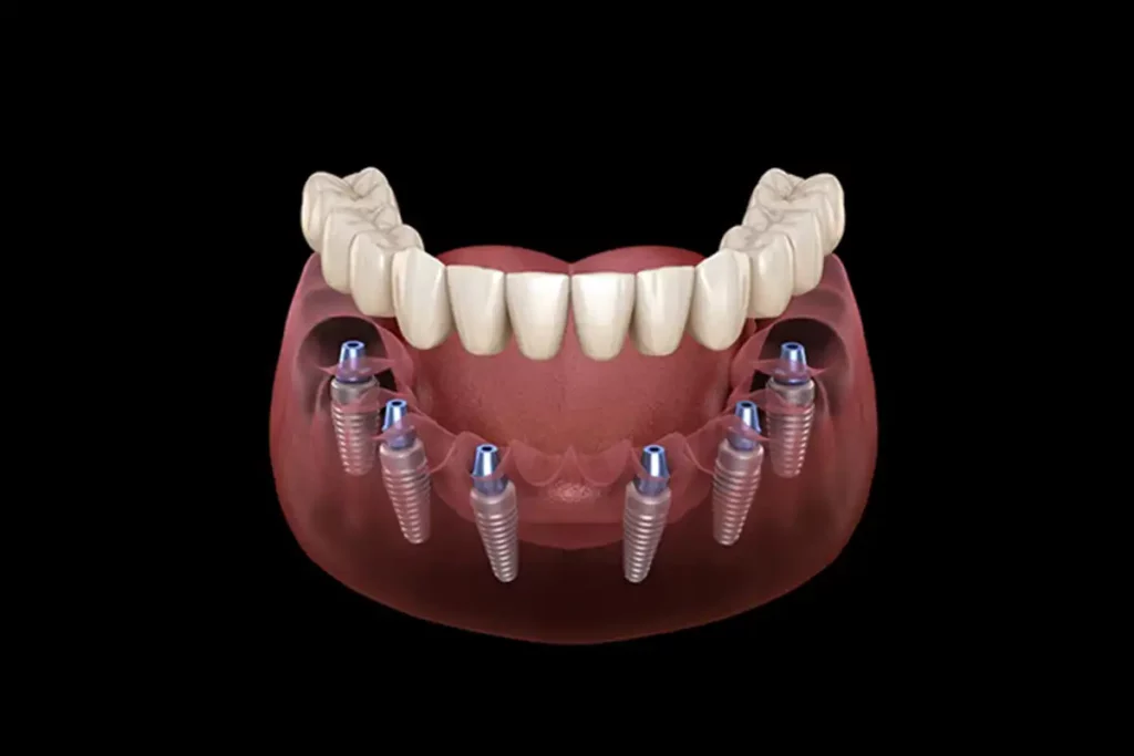 Photo implant dentaire